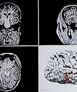 Magnetoencefalografia MEG-